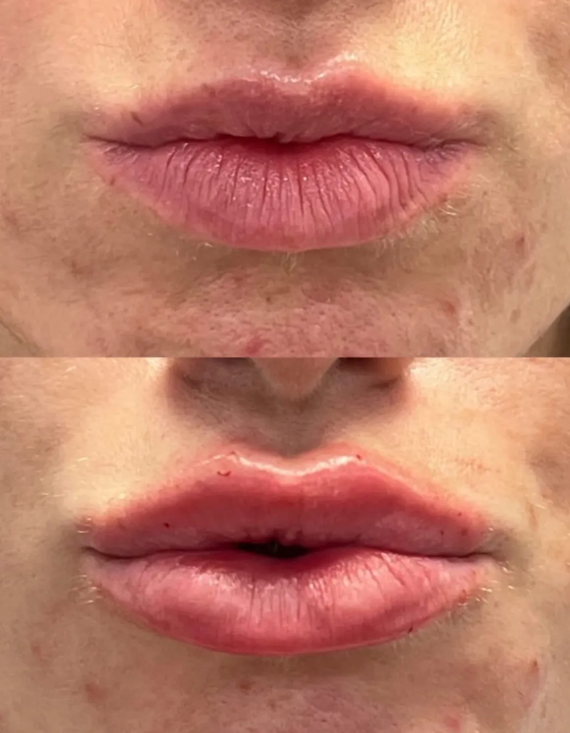Filler before and after — Patient 1