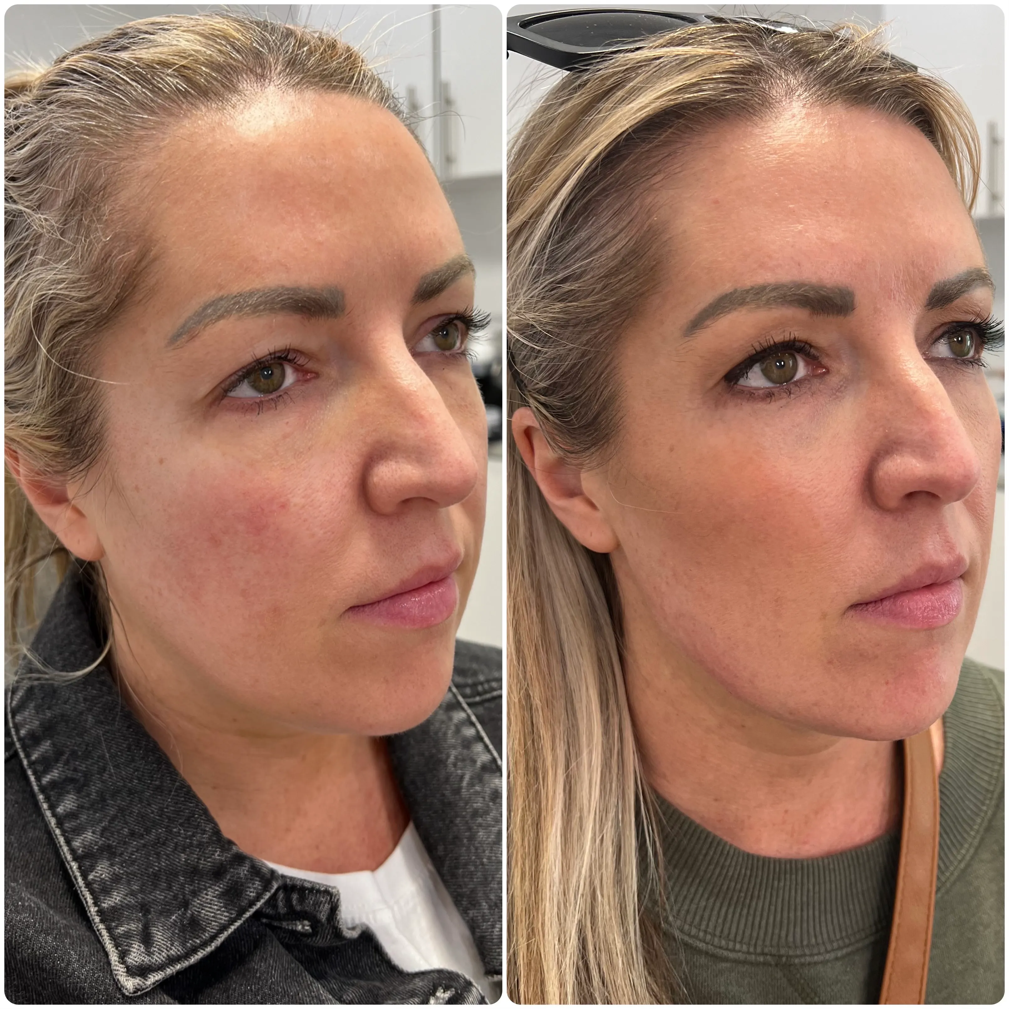 Full face filler before and after — Patient 5