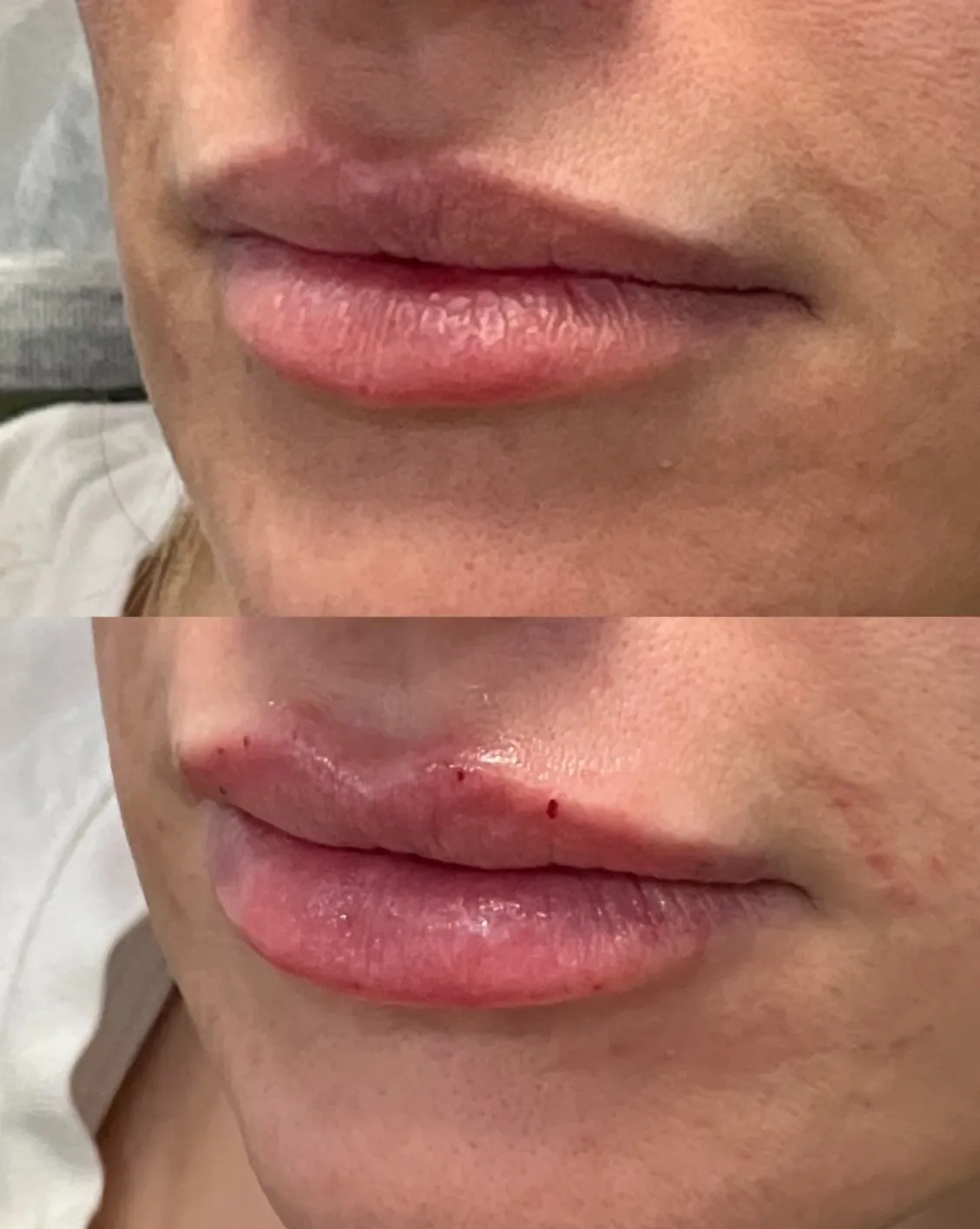 Lip filler before and after — Patient 3