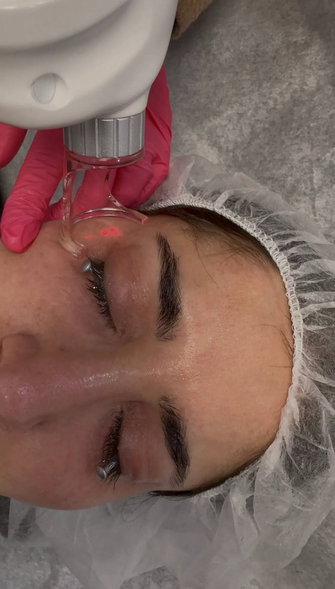Laser Genesis Before and After