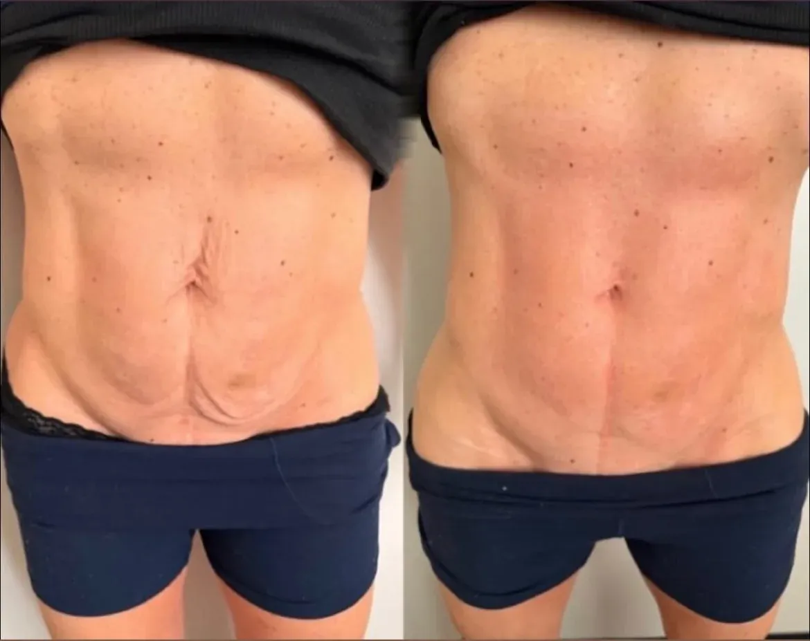 XERF skin tightening before and after — abdomen