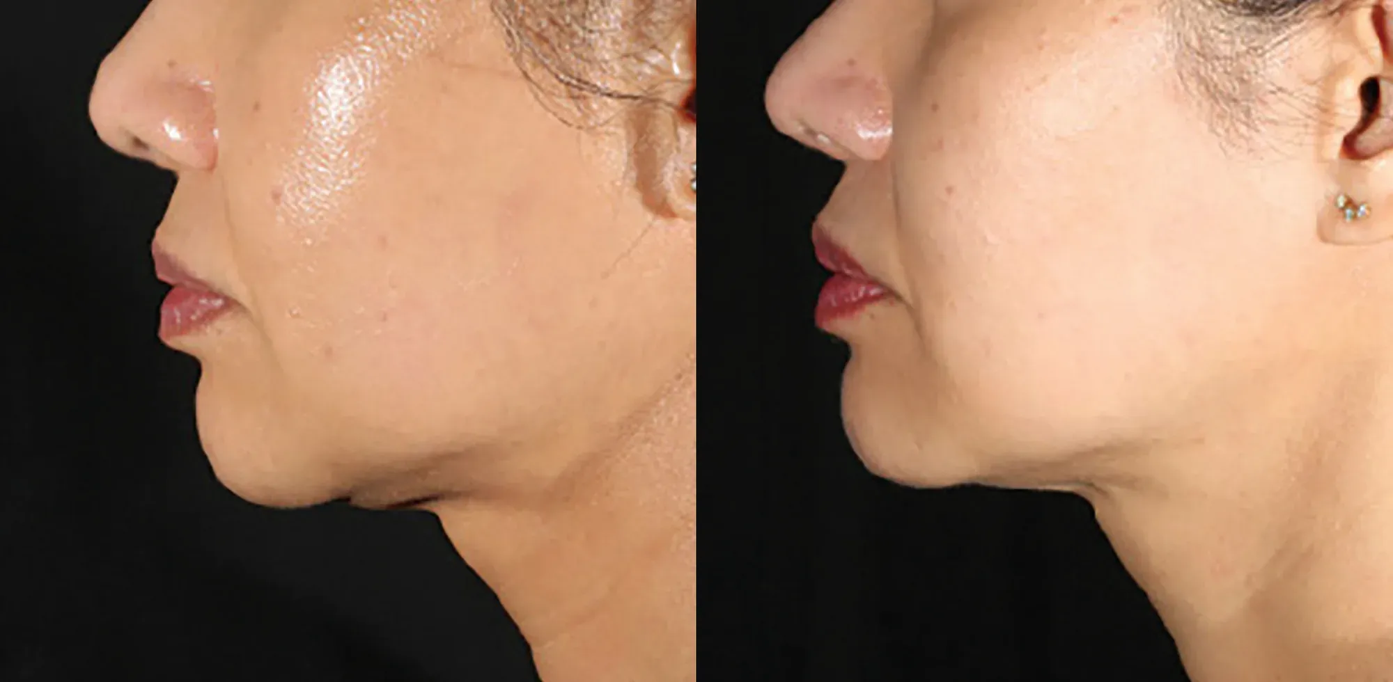 XERF skin tightening before and after — chin and jawline, profile view, after 1 treatment