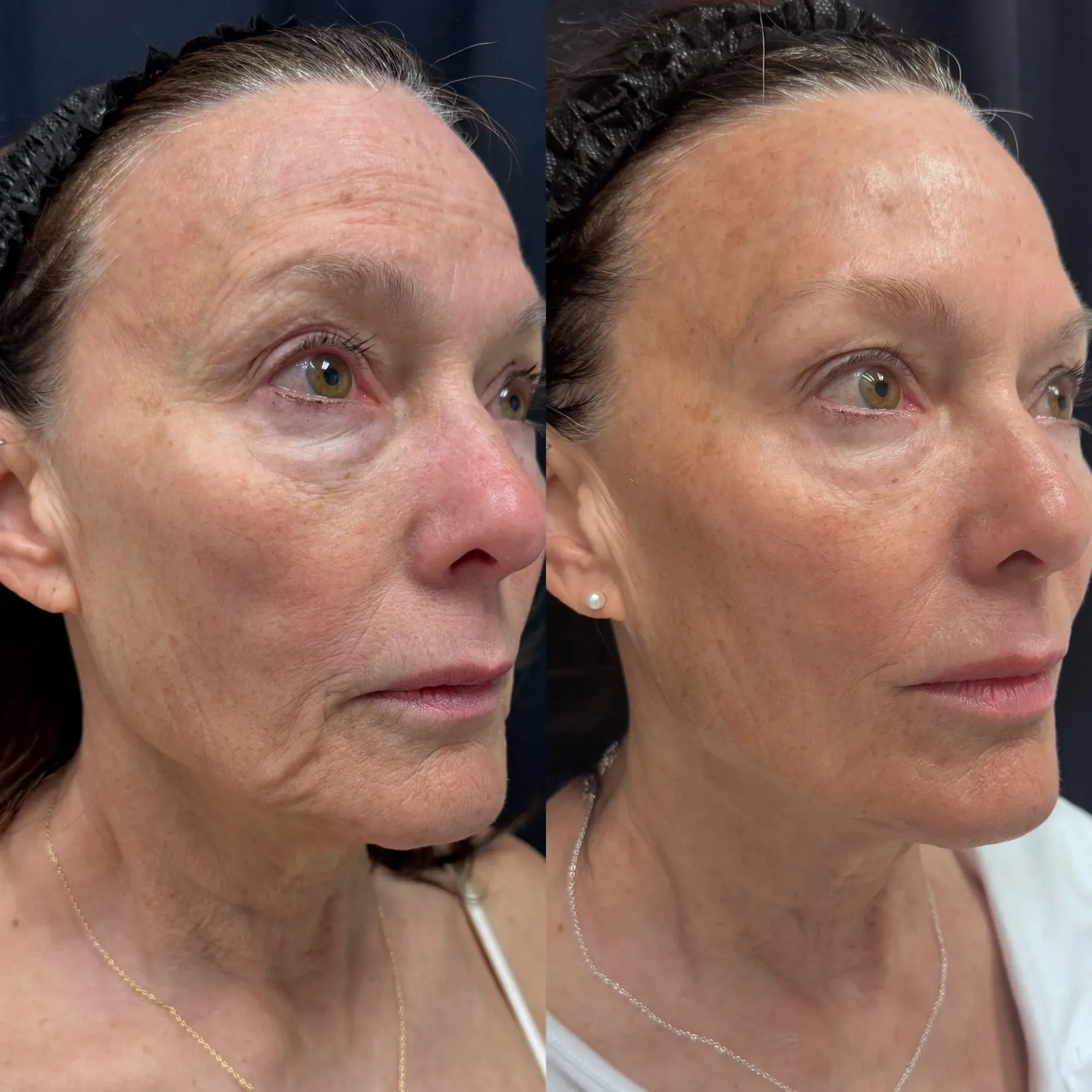 XERF skin tightening before and after — three-quarter view