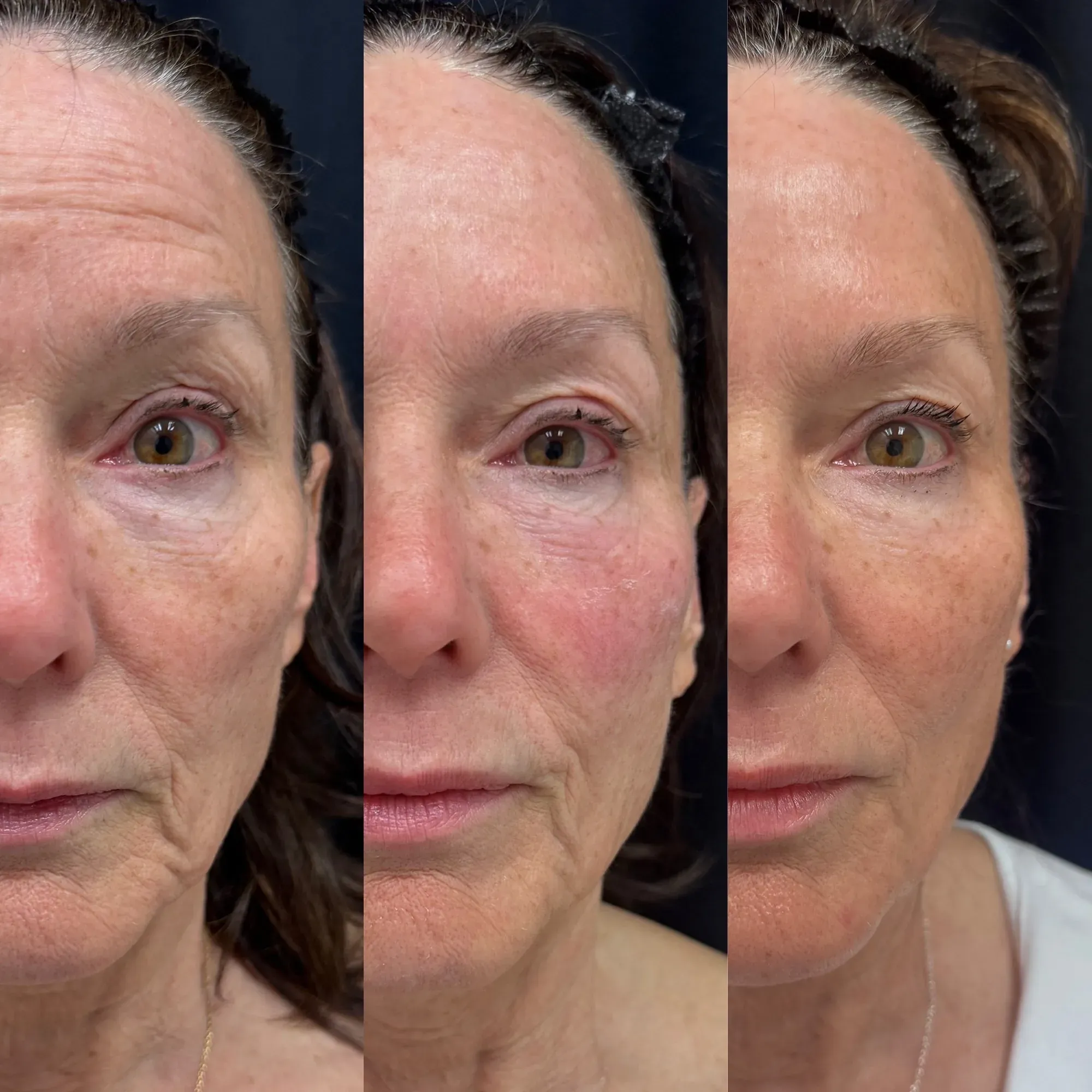 XERF skin tightening before and after — full face, front view