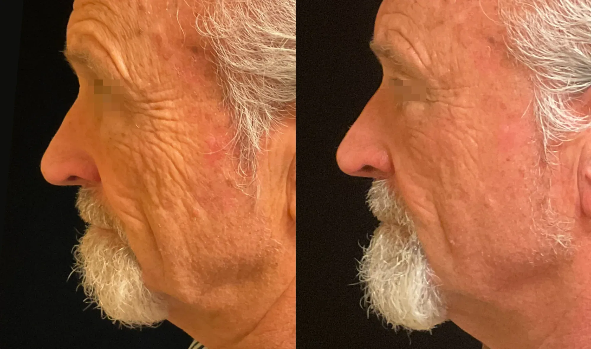 XERF skin tightening before and after — profile view, 1 month after 1 treatment