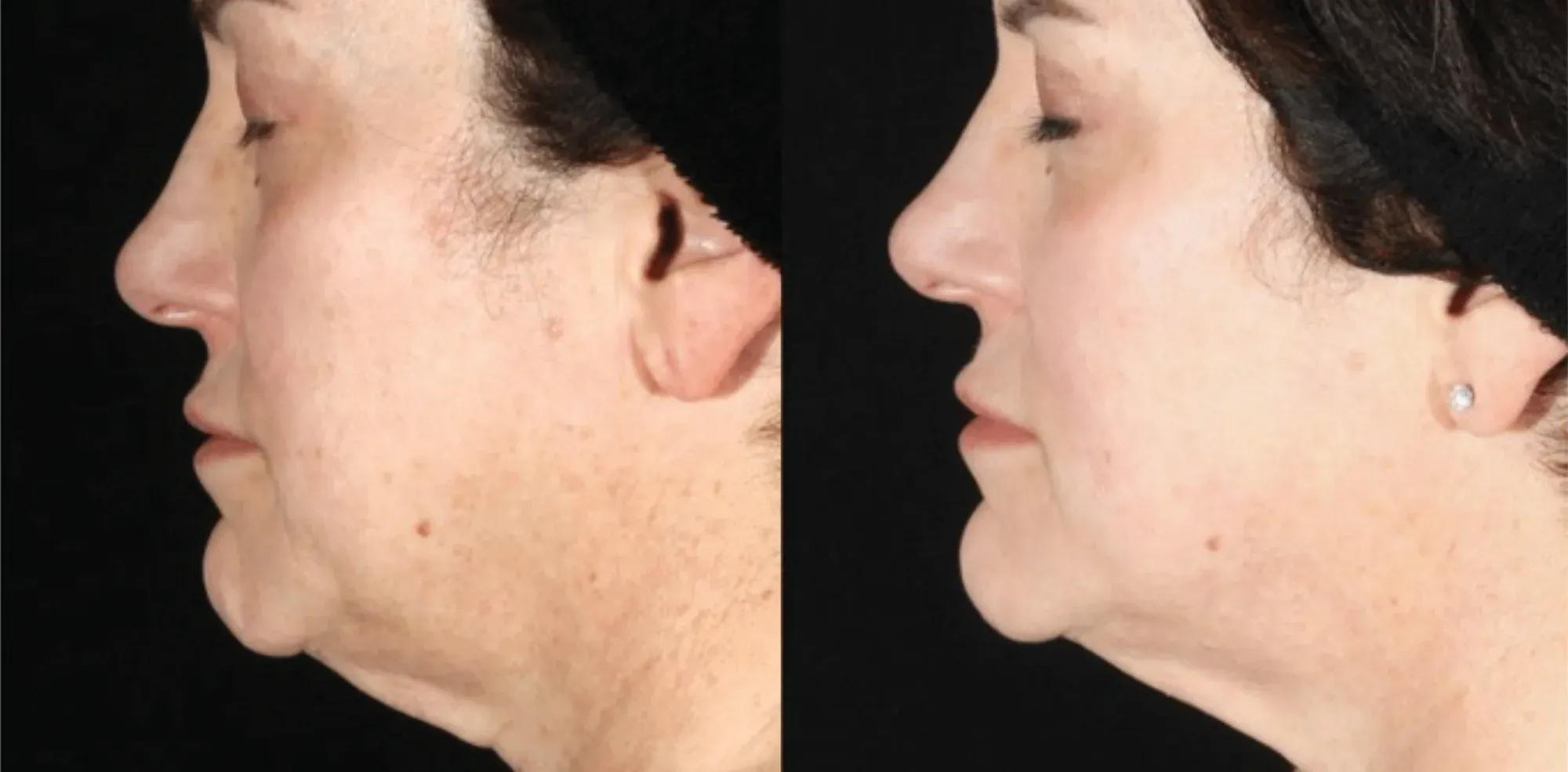 XERF skin tightening before and after — jawline and under-chin, profile view, after 2 treatments