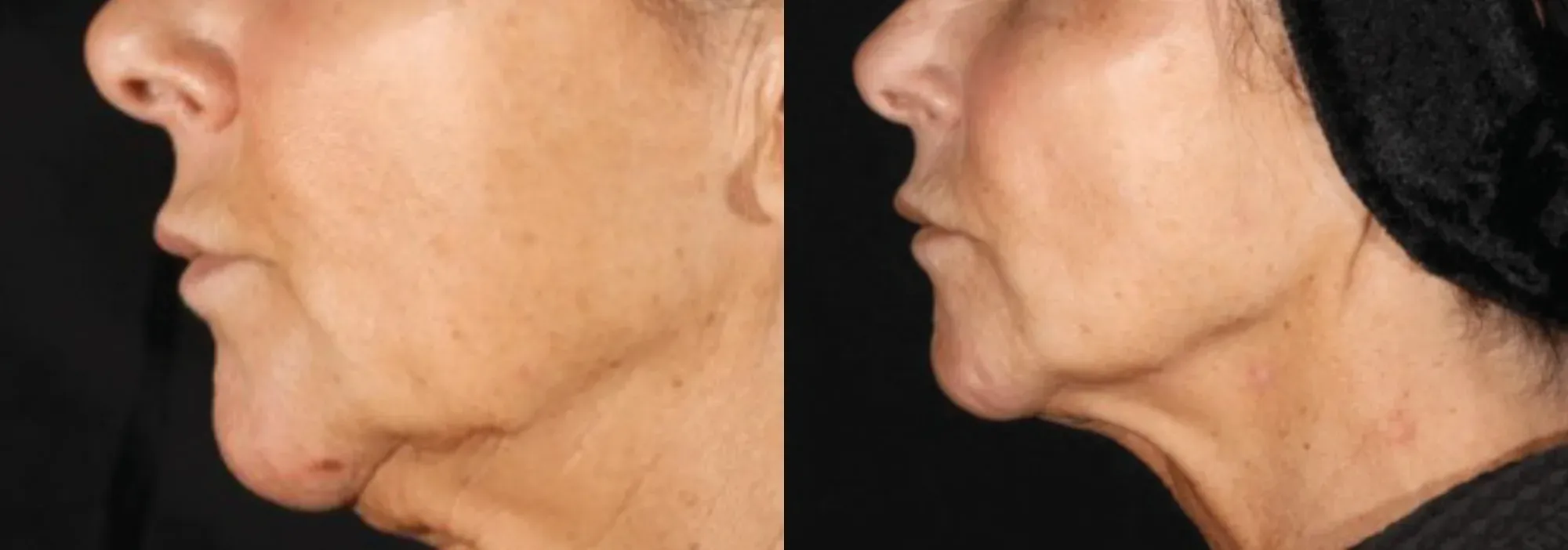 XERF skin tightening before and after — jowls and neck, profile view, after 2 treatments