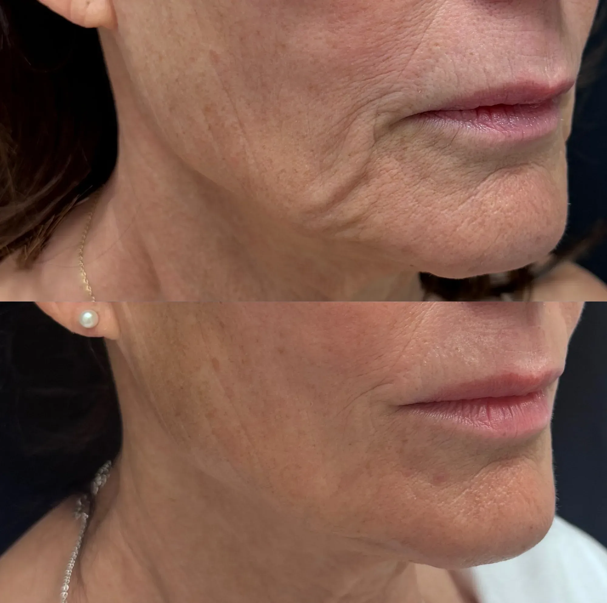 XERF skin tightening before and after — jawline and lower face