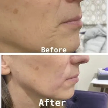 Filler before and after — Patient 3