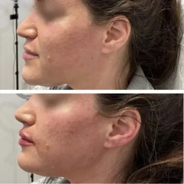 Filler before and after — Patient 4
