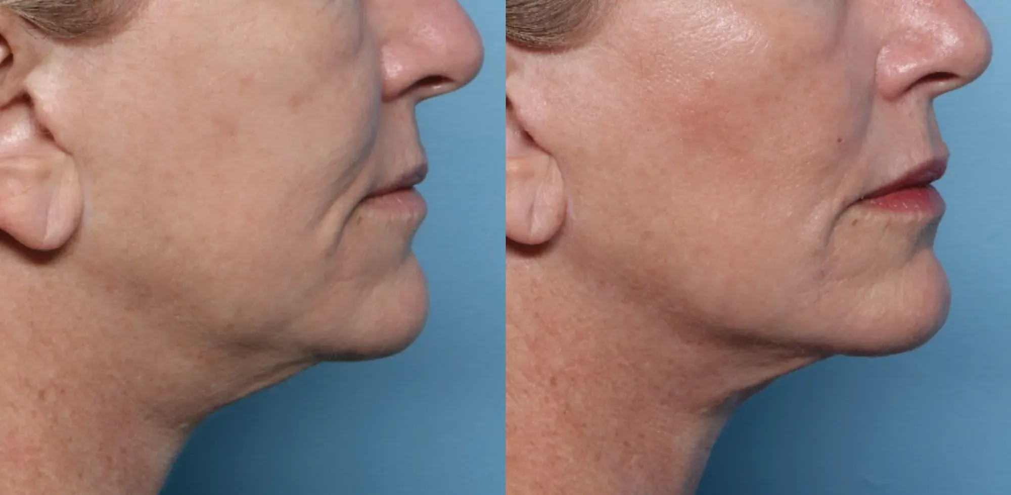 XERF skin tightening before and after — neck and under-chin, profile view, after 1 treatment