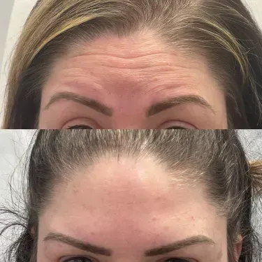 Neurotoxin/Botox before and after — Patient 7