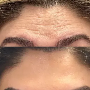 Neurotoxin/Botox before and after — Patient 8