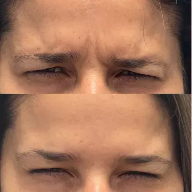 Neurotoxin/Botox before and after — Patient 9