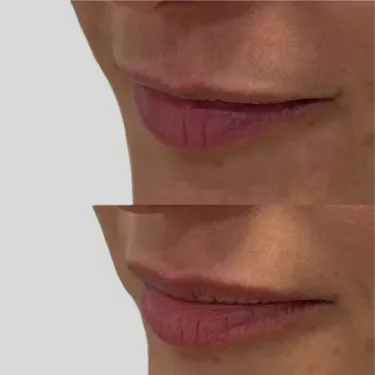 Filler before and after — Patient 10