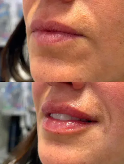 Before and after treatment result at GLOW by Elena Reitman MD