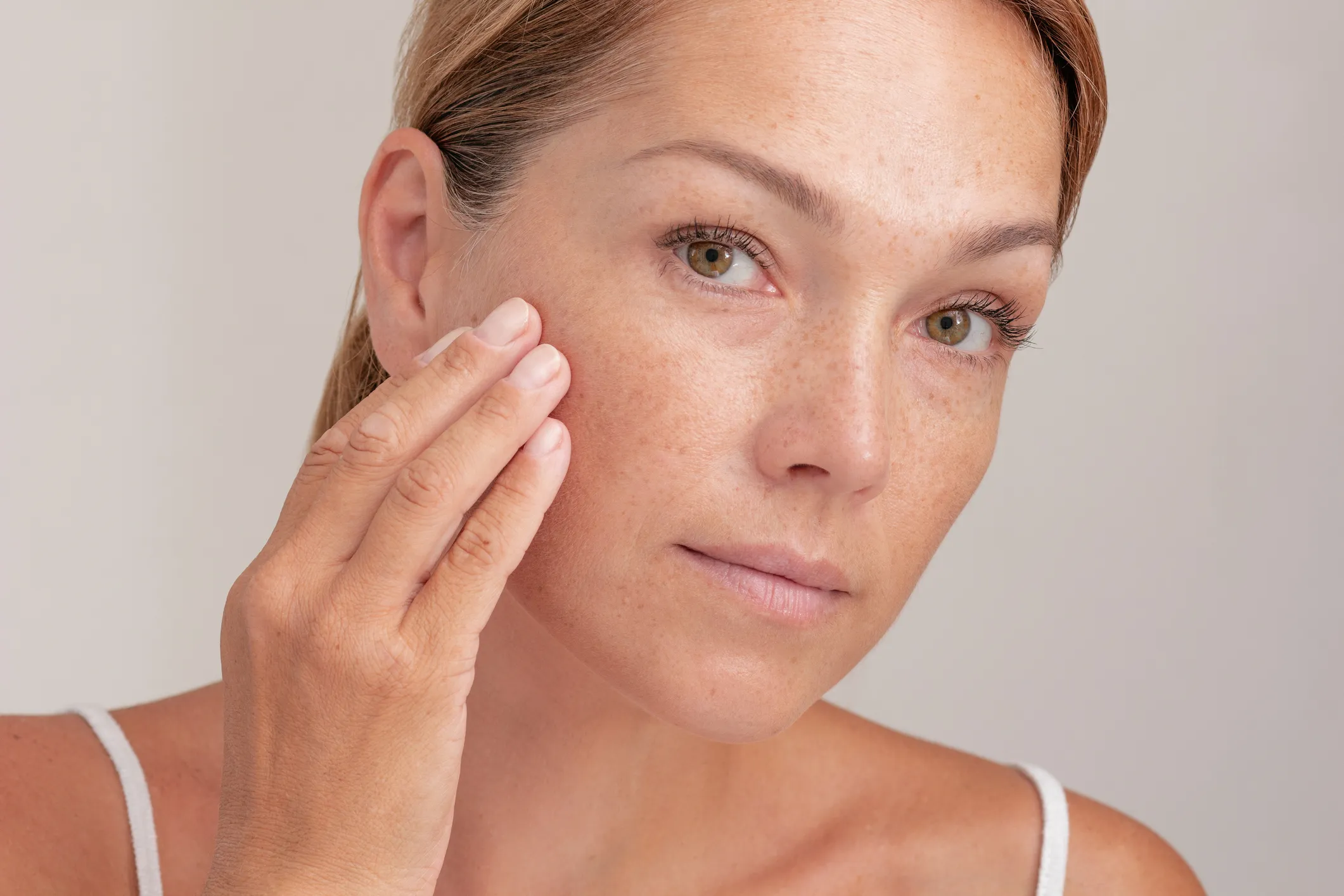 Laser Pigment Removal treatment at GLOW by Elena Reitman MD