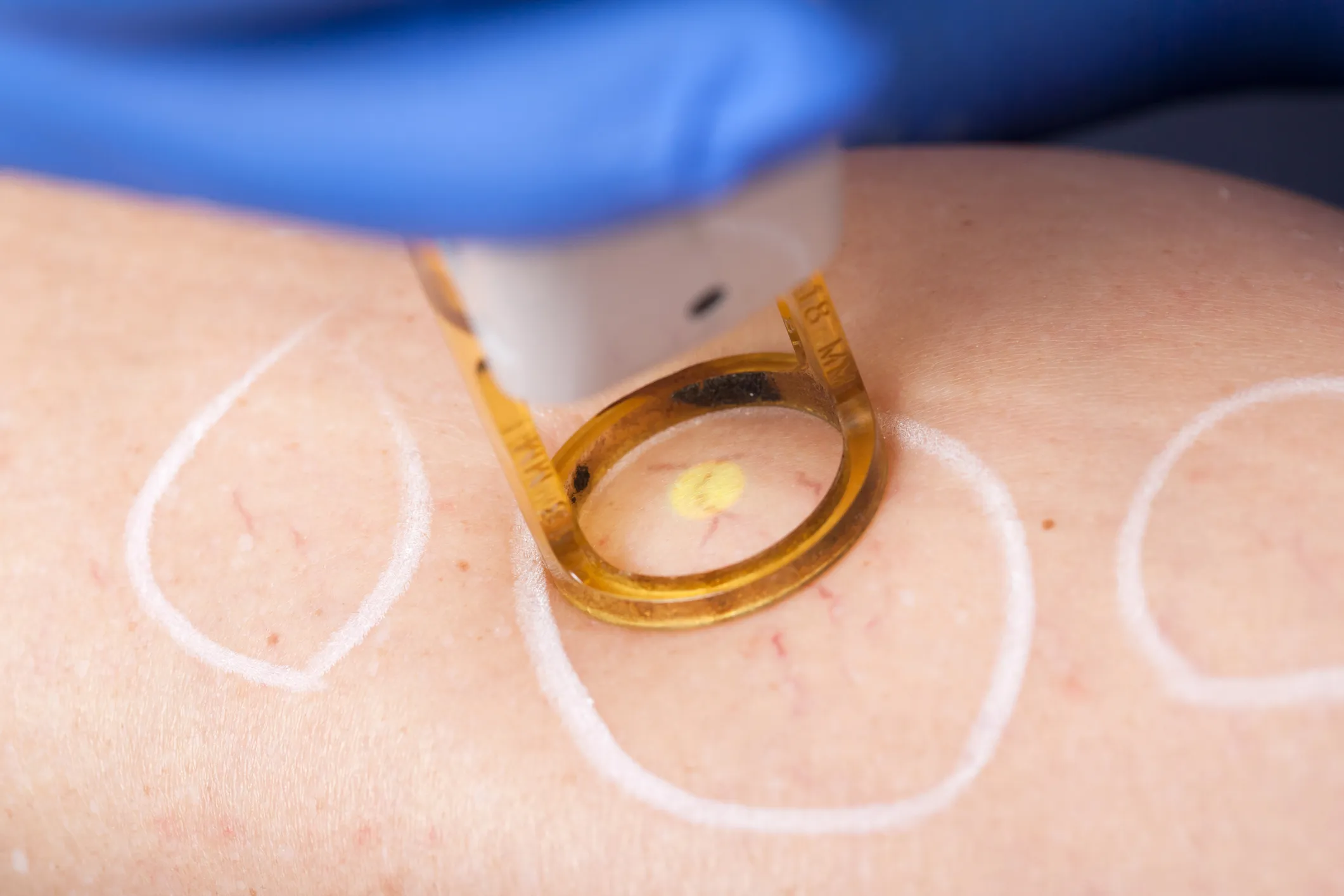 Laser Vein Removal treatment at GLOW by Elena Reitman MD